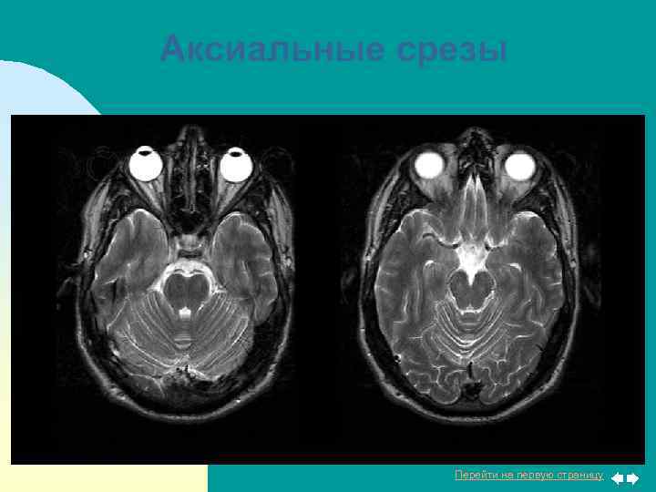 Аксиальные срезы Перейти на первую страницу 