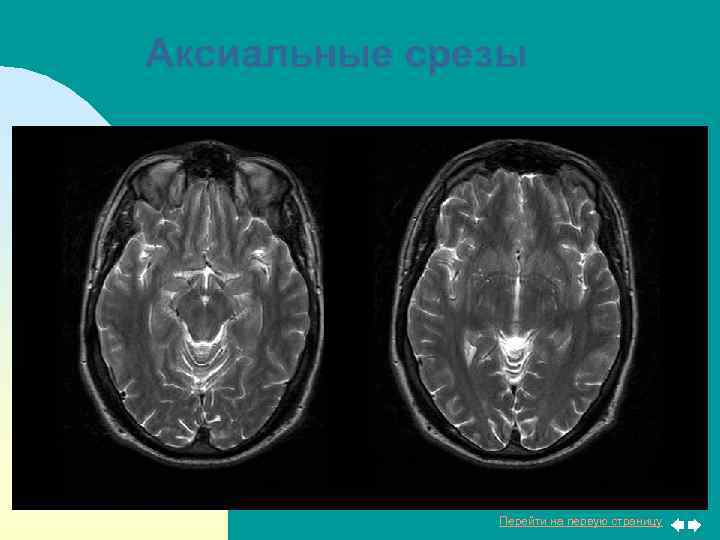 Аксиальные срезы Перейти на первую страницу 