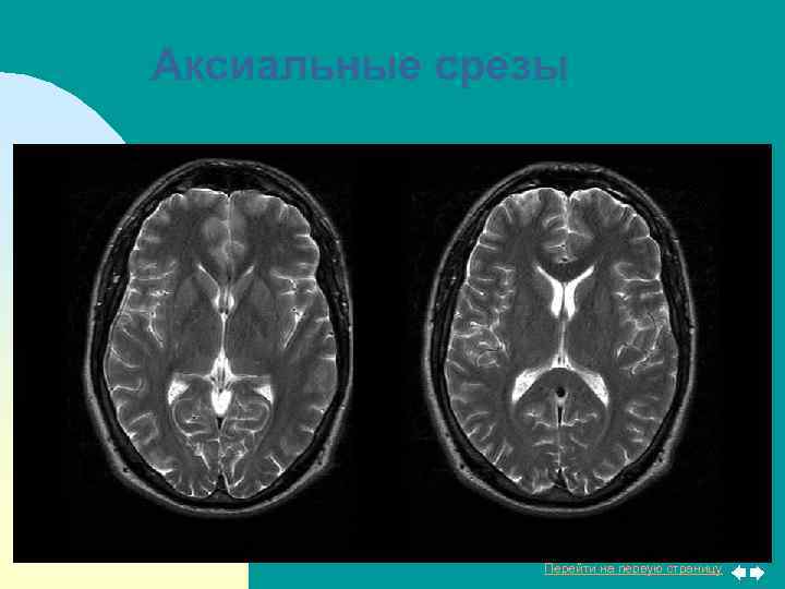 Аксиальные срезы Перейти на первую страницу 