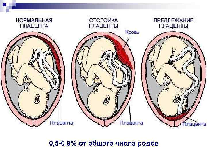 0, 5 -0, 8% от общего числа родов 