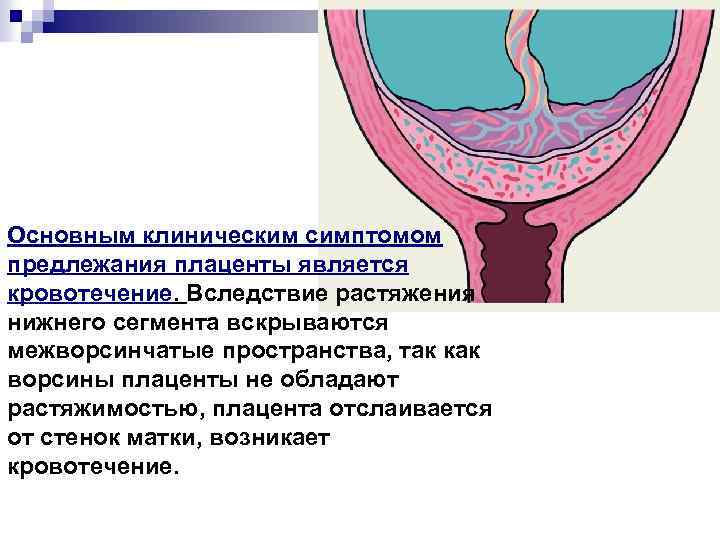 Основным клиническим симптомом предлежания плаценты является кровотечение. Вследствие растяжения нижнего сегмента вскрываются межворсинчатые пространства,