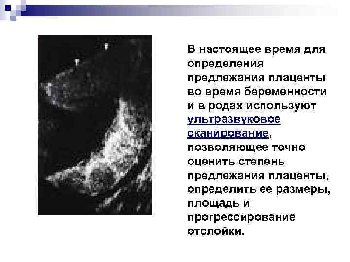 В настоящее время для определения предлежания плаценты во время беременности и в родах используют