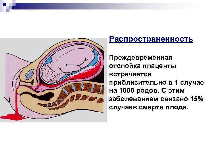 Отслойка плаценты фото выделений