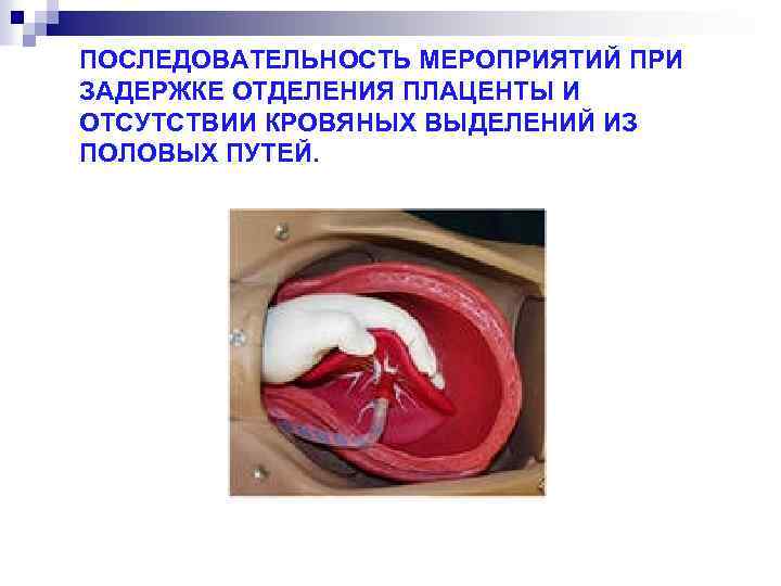 ПОСЛЕДОВАТЕЛЬНОСТЬ МЕРОПРИЯТИЙ ПРИ ЗАДЕРЖКЕ ОТДЕЛЕНИЯ ПЛАЦЕНТЫ И ОТСУТСТВИИ КРОВЯНЫХ ВЫДЕЛЕНИЙ ИЗ ПОЛОВЫХ ПУТЕЙ. 