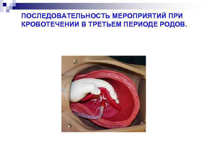 ПОСЛЕДОВАТЕЛЬНОСТЬ МЕРОПРИЯТИЙ ПРИ КРОВОТЕЧЕНИИ В ТРЕТЬЕМ ПЕРИОДЕ РОДОВ. 