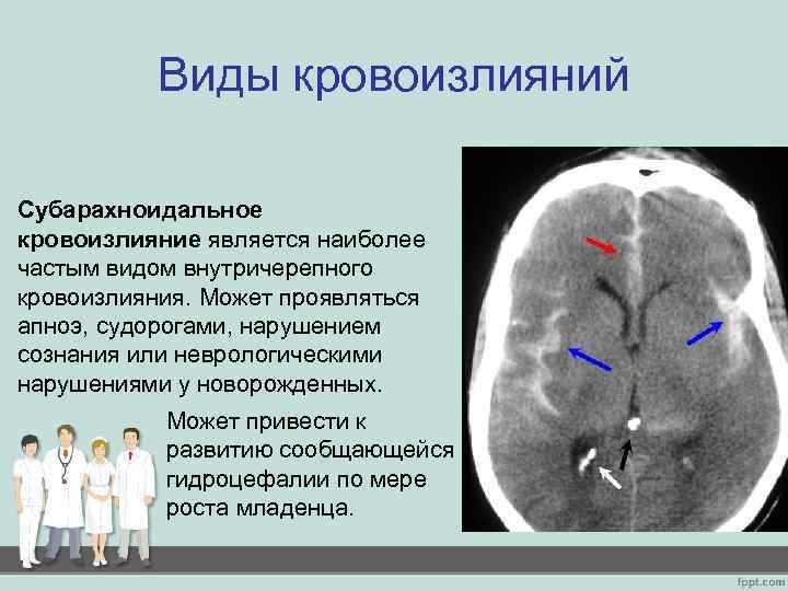 Кровоизлияние головного мозга новорожденного