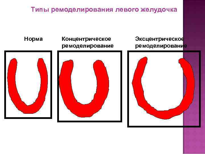 Миокарда левого желудочка