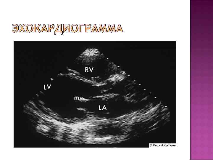 ЭХОКАРДИОГРАММА 