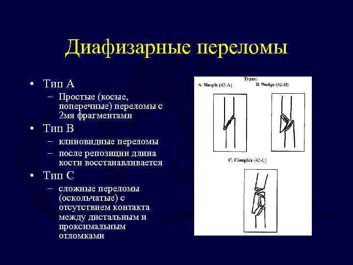 Диафизарные переломы • Тип A – Простые (косые, поперечные) переломы с 2 мя фрагментами