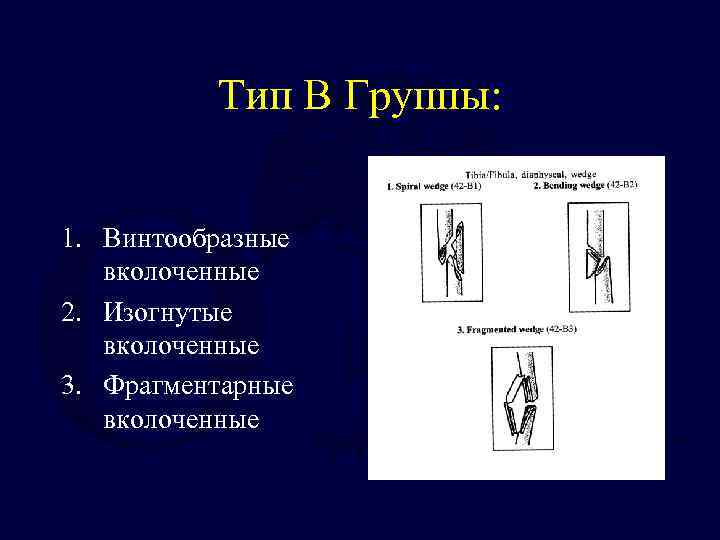 Тип B Группы: 1. Винтообразные вколоченные 2. Изогнутые вколоченные 3. Фрагментарные вколоченные 