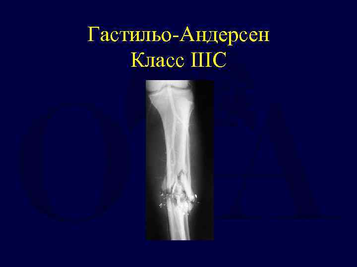 Гастильо-Андерсен Класс IIIC 