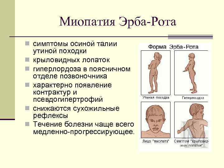 Миопатия что это. Ювенильная миопатия Эрба. Миопатия ювенильная форма Эрба.