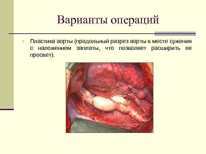 Варианты операций • Пластика аорты (продольный разрез аорты в месте сужения с наложением заплаты,