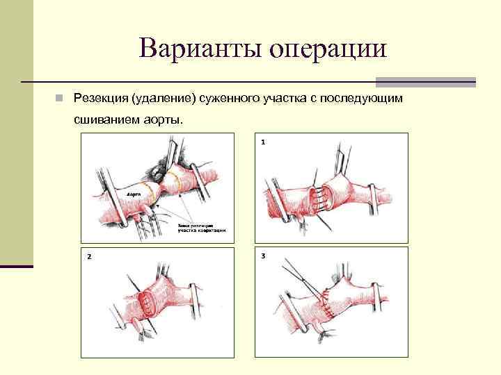 Варианты операции n Резекция (удаление) суженного участка с последующим сшиванием аорты. 