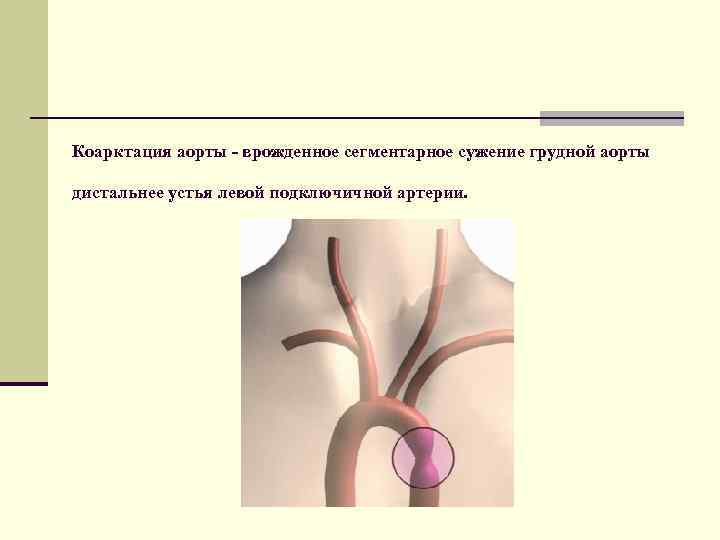 Коарктация аорты - врожденное сегментарное сужение грудной аорты дистальнее устья левой подключичной артерии. 