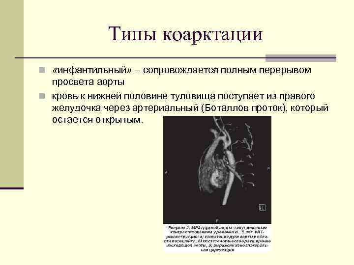 Типы коарктации n «инфантильный» – сопровождается полным перерывом просвета аорты n кровь к нижней