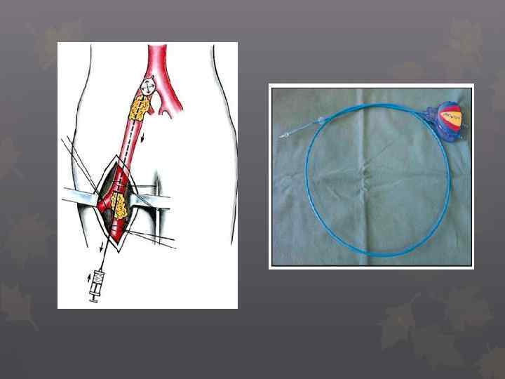 Схема операции удаления эмбола из бифуркации аорты