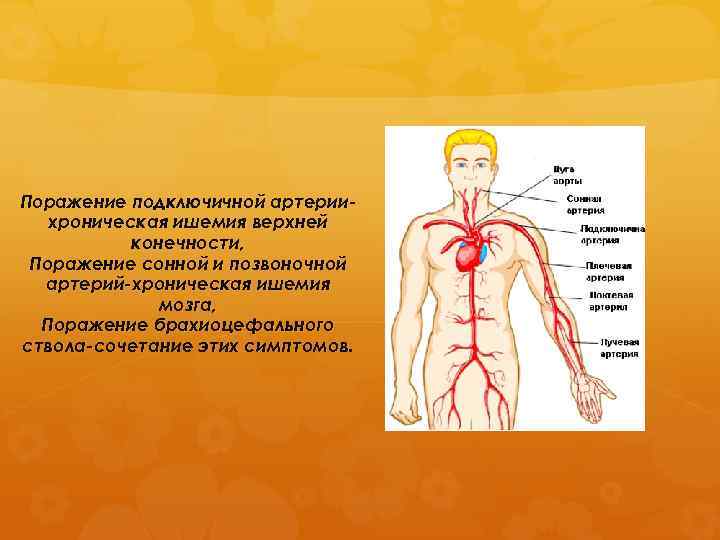 Поражение подключичной артериихроническая ишемия верхней конечности, Поражение сонной и позвоночной артерий-хроническая ишемия мозга, Поражение