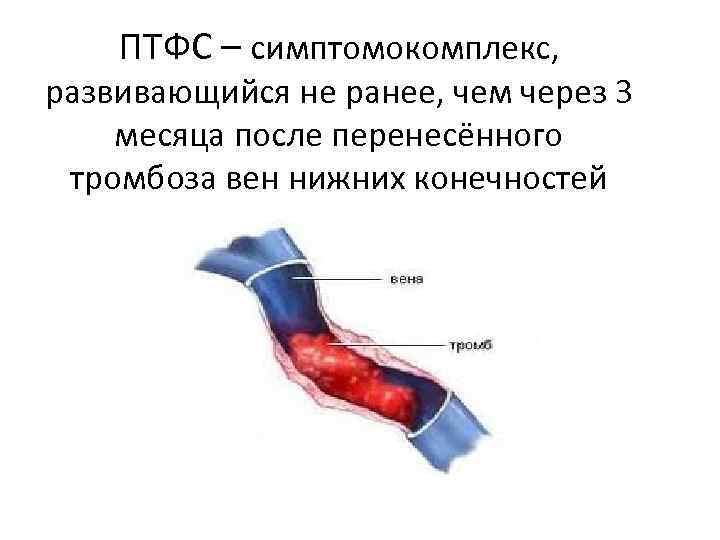 Посттромбофлебитический синдром презентация - 84 фото