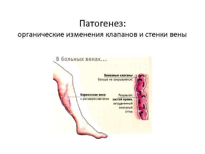 Патогенез: органические изменения клапанов и стенки вены 