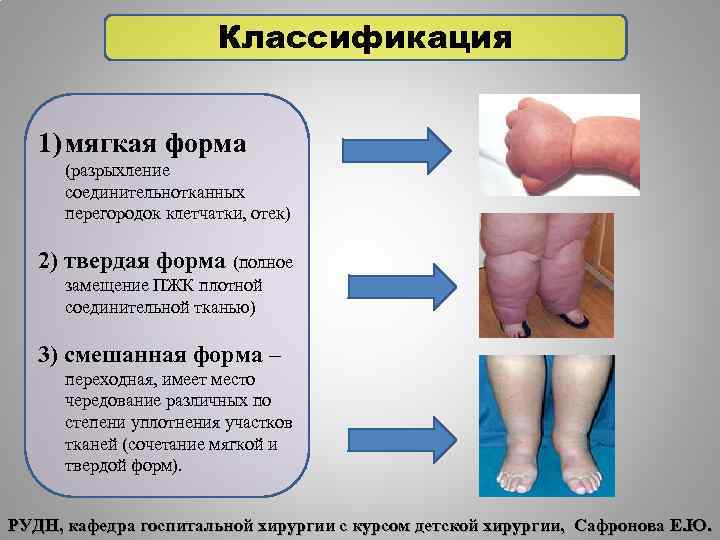 Классификация 1) мягкая форма (разрыхление соединительнотканных перегородок клетчатки, отек) 2) твердая форма (полное замещение