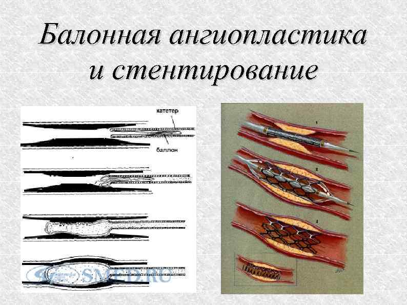 Балонная ангиопластика и стентирование 