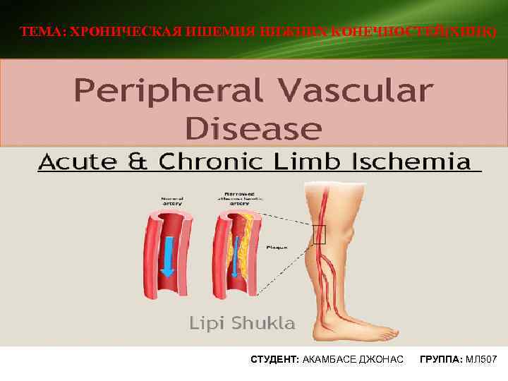 ТЕМА: ХРОНИЧЕСКАЯ ИШЕМИЯ НИЖНИХ КОНЕЧНОСТЕЙ(ХИНК) СТУДЕНТ: АКАМБАСЕ ДЖОНАС ГРУППА: МЛ 507 