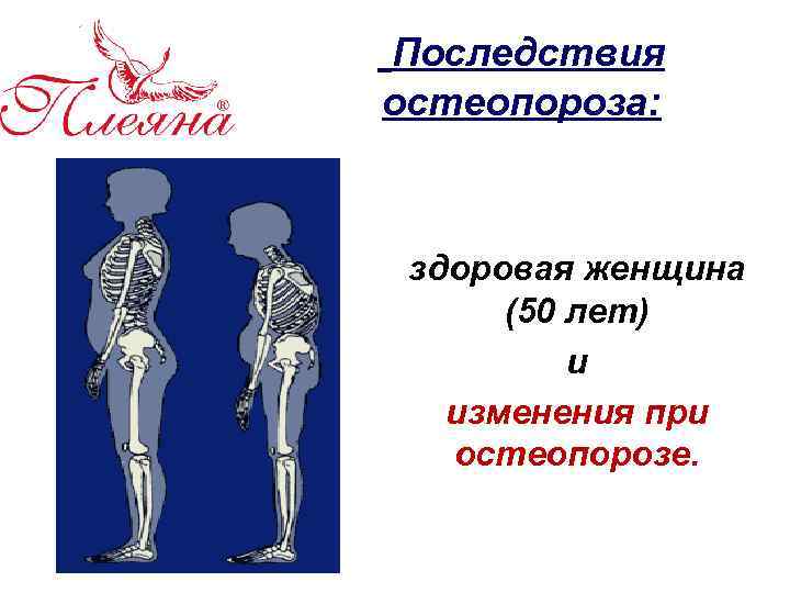 Последствия остеопороза: здоровая женщина (50 лет) и изменения при остеопорозе. 