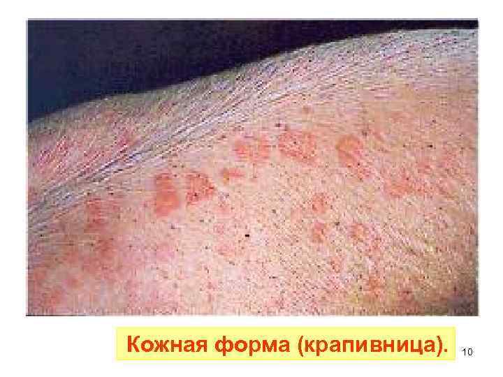 Кожная форма (крапивница). 10 