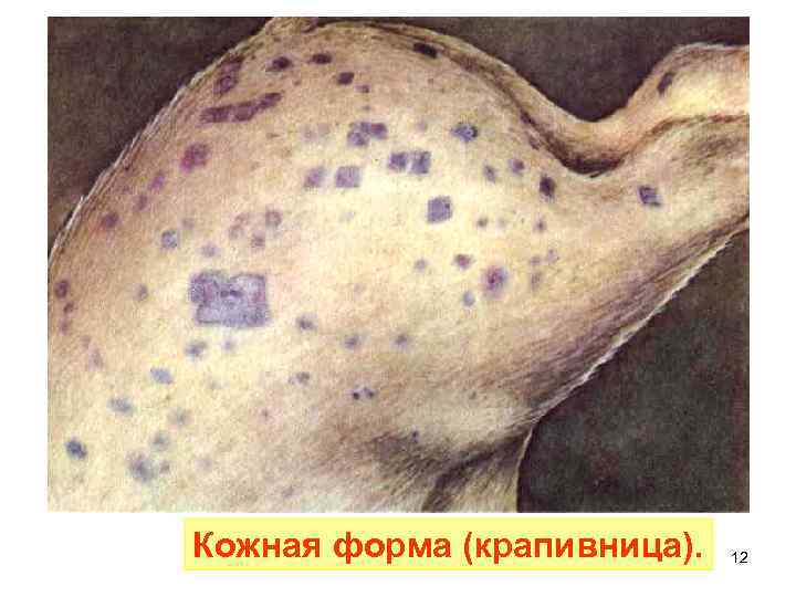Кожная форма (крапивница). 12 