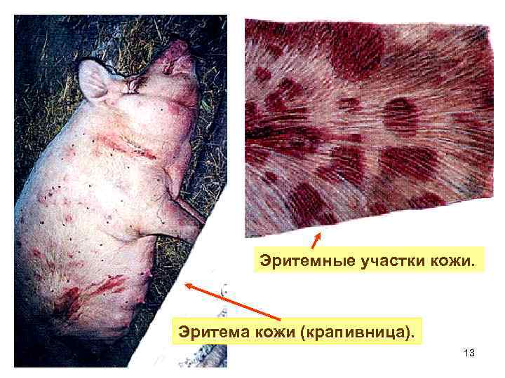 Эритемные участки кожи. Эритема кожи (крапивница). 13 