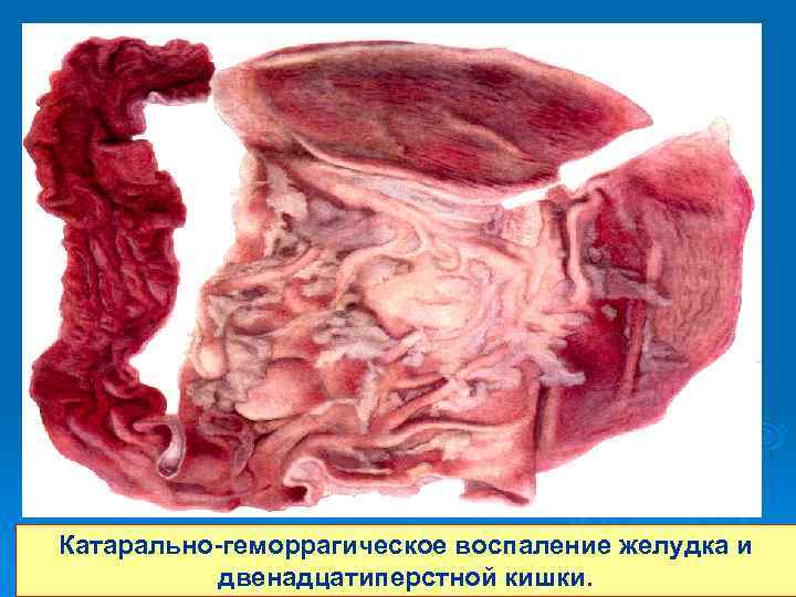 Катарально-геморрагическое воспаление желудка и 16 двенадцатиперстной кишки. 