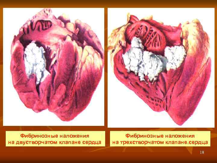 Фибринозные наложения на двустворчатом клапане сердца. Фибринозные наложения на трехстворчатом клапане. сердца 18 