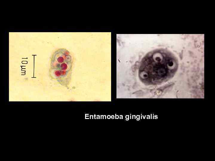 Entamoeba gingivalis 