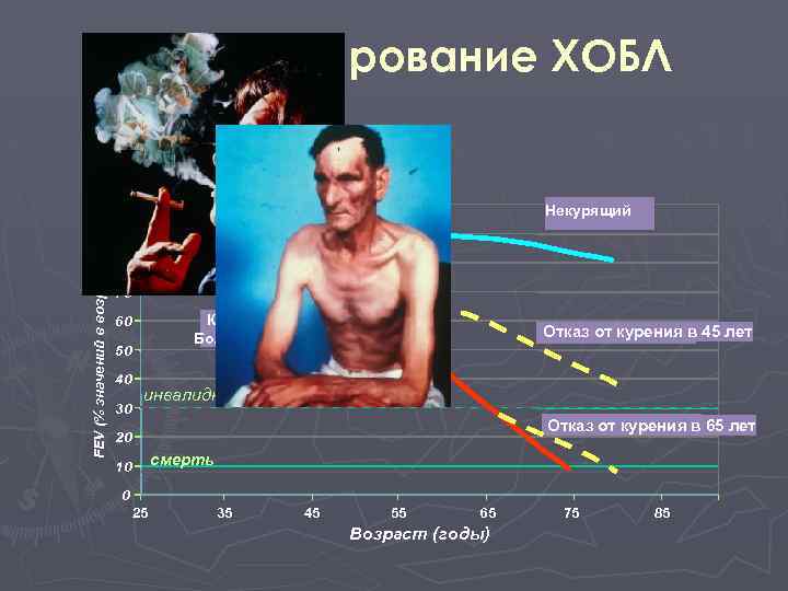 FEV (% значений в возрасте 25 лет Прогрессирование ХОБЛ 100 Некурящий 90 80 70