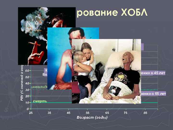 FEV (% значений в возрасте 25 лет Прогрессирование ХОБЛ 100 Некурящий 90 80 70