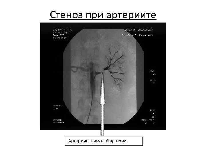 Стеноз при артериите 