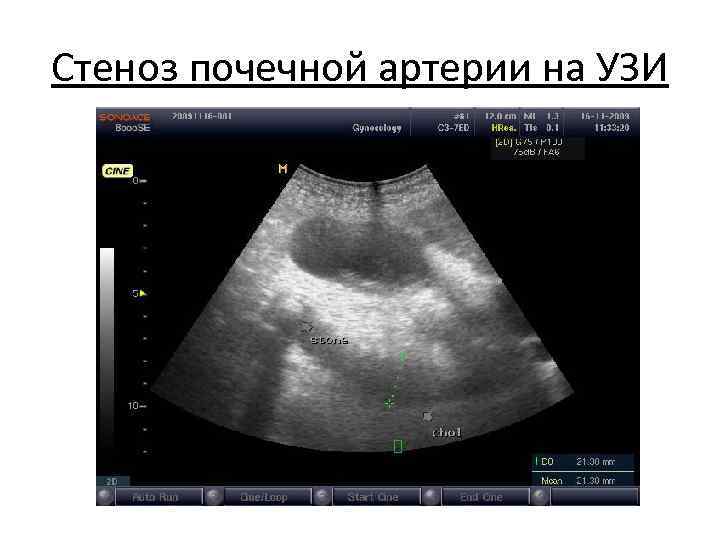 Стеноз почечной артерии на УЗИ 