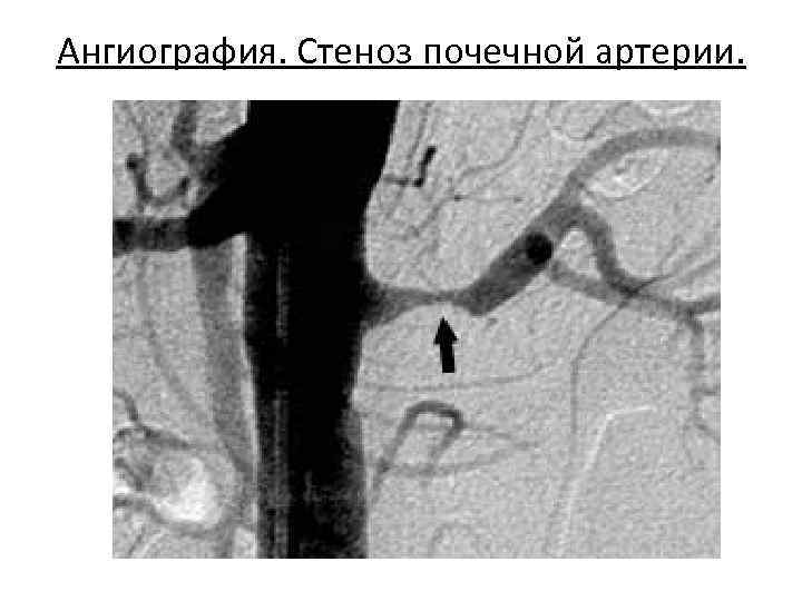 Ангиография. Стеноз почечной артерии. 