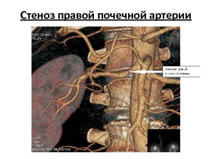 Стеноз правой почечной артерии 