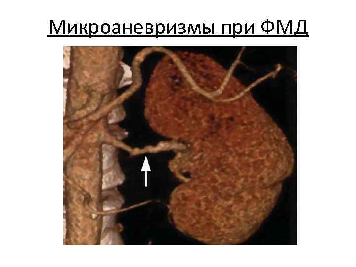 Микроаневризмы при ФМД 