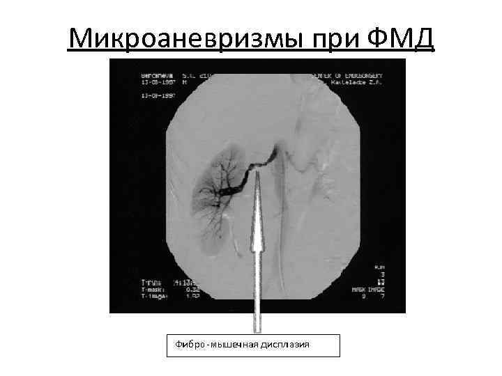 Микроаневризмы при ФМД 
