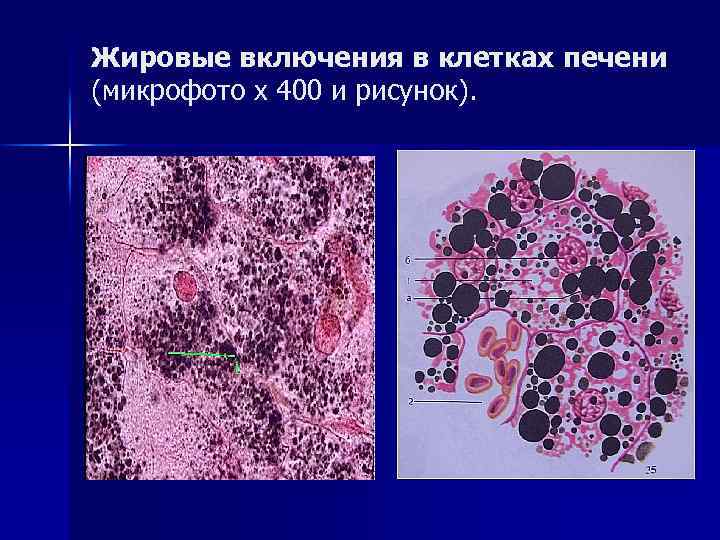 Жировые включения в клетках печени (микрофото х 400 и рисунок). 