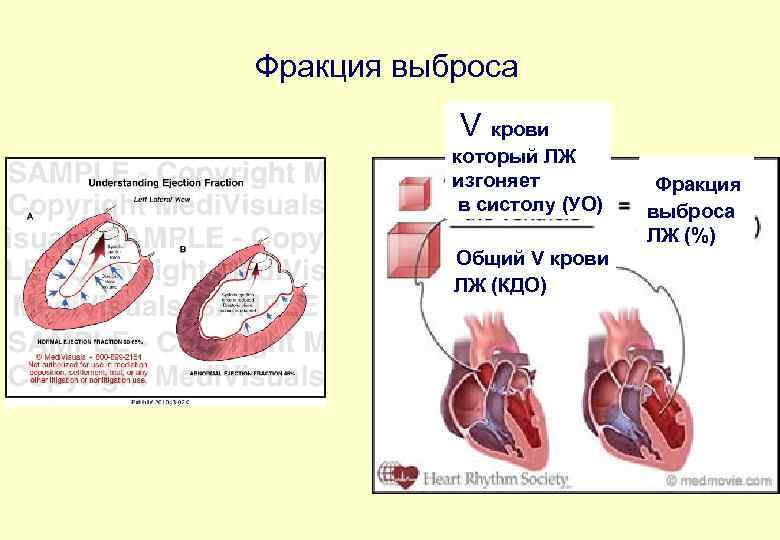 Фракция выброса V крови который ЛЖ изгоняет в систолу (УО) Общий V крови ЛЖ