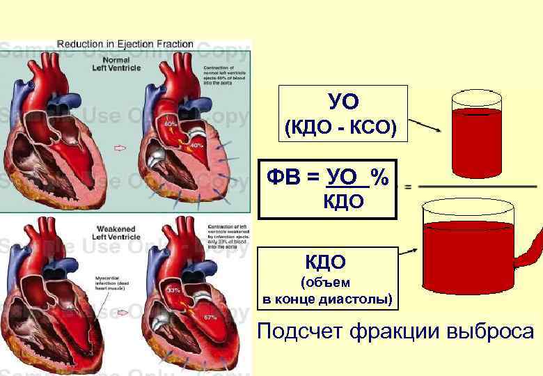 УО (КДО - КСО) ФВ = УО % КДО (объем в конце диастолы) Подсчет