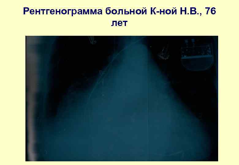 Рентгенограмма больной К-ной Н. В. , 76 лет 