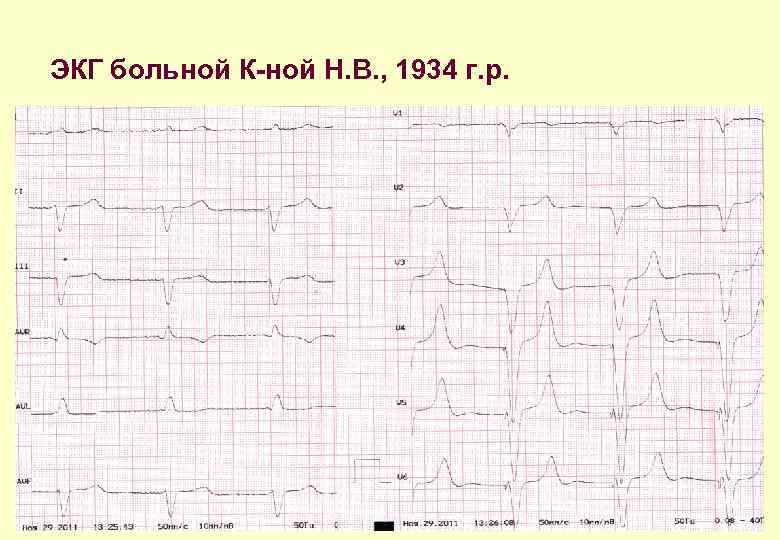 ЭКГ больной К-ной Н. В. , 1934 г. р. 