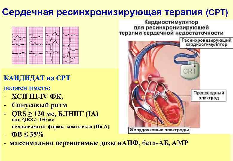 Сердечная ресинхронизирующая терапия (СРТ) КАНДИДАТ на СРТ должен иметь: - ХСН III-IV ФК, -