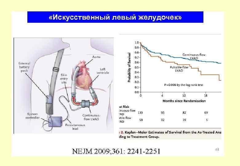  «Искусственный левый желудочек» 