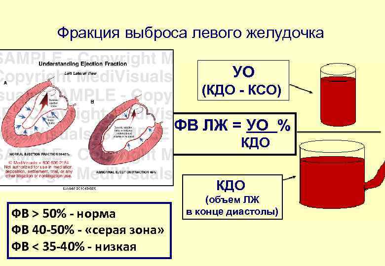 Фракция выброса левого желудочка УО (КДО - КСО) ФВ ЛЖ = УО % КДО